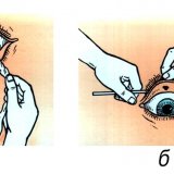 Извлечение инородного тела из глаза