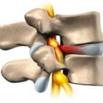 Межпозвонковая грыжа шейный отдел