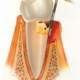 Пародонтоз лечение народными методами