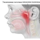 Лечение хронического аденоидита у детей