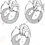 Самые распространенные пороки сердца у детей